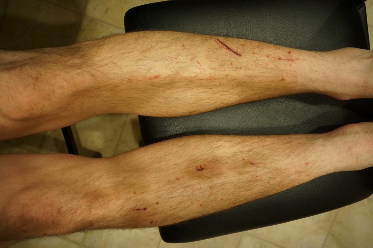 cuts and bruises on legs from off trail hiking