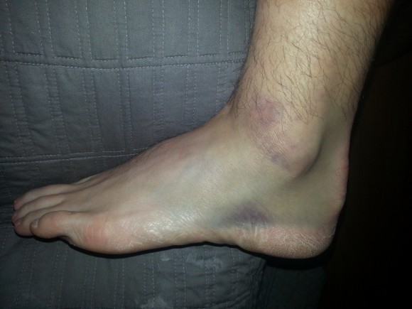 ankle sprain
